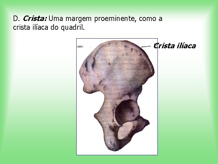 D. Crista: Uma margem proeminente, como a crista ilíaca do quadril. Crista ilíaca 