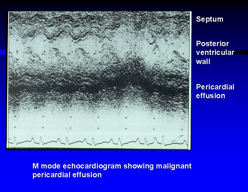 Septum Posterior ventricular wall Pericardial effusion M mode echocardiogram showing malignant pericardial effusion 