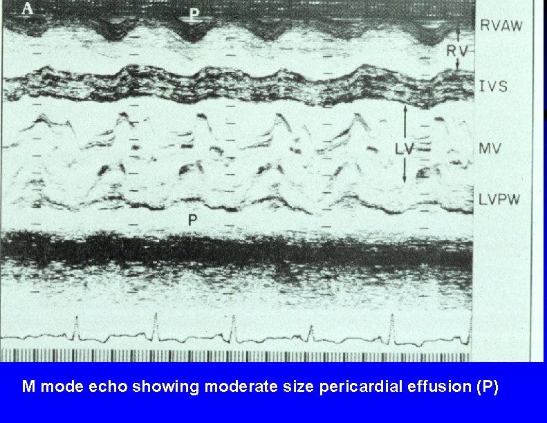 M mode echo showing moderate size pericardial effusion (P) 