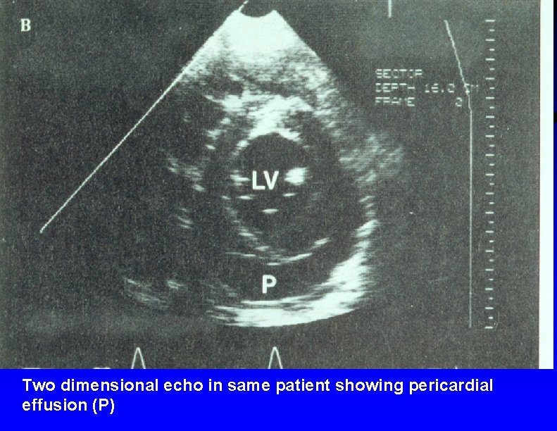 Two dimensional echo in same patient showing pericardial effusion (P) 