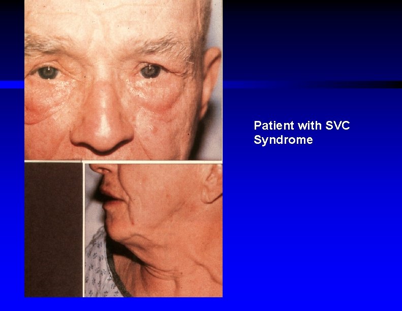 Patient with SVC Syndrome 