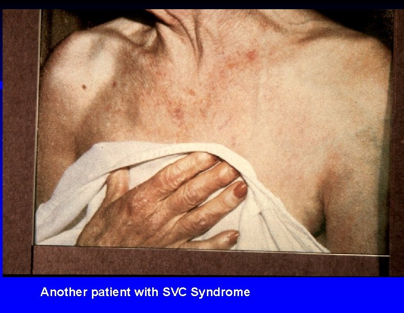 Another patient with SVC Syndrome 