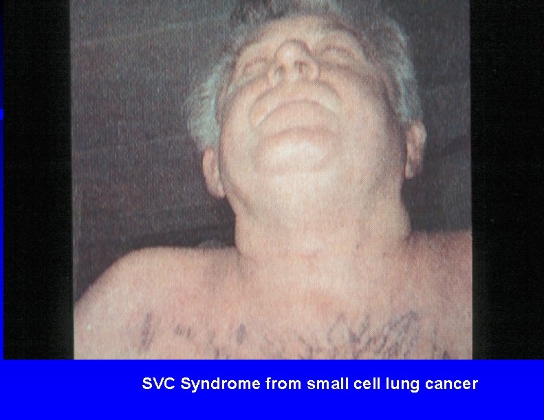 SVC Syndrome from small cell lung cancer 