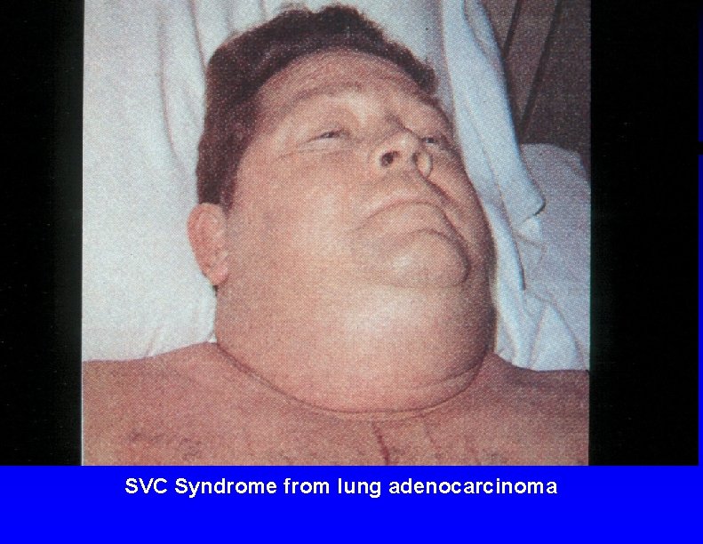 SVC Syndrome from lung adenocarcinoma 