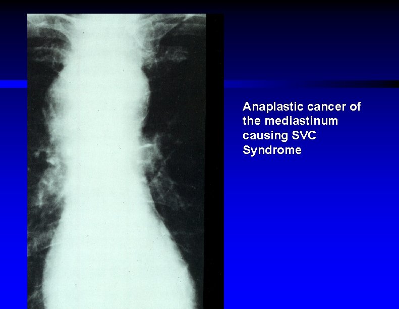 Anaplastic cancer of the mediastinum causing SVC Syndrome 