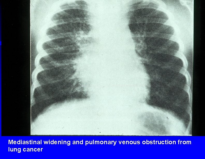Mediastinal widening and pulmonary venous obstruction from lung cancer 