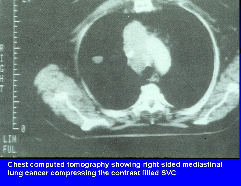 Chest computed tomography showing right sided mediastinal lung cancer compressing the contrast filled SVC