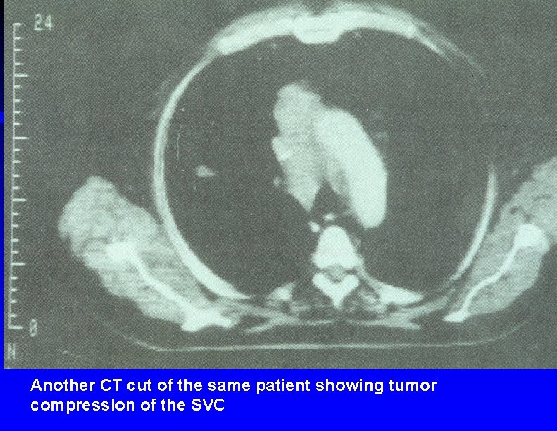 Another CT cut of the same patient showing tumor compression of the SVC 