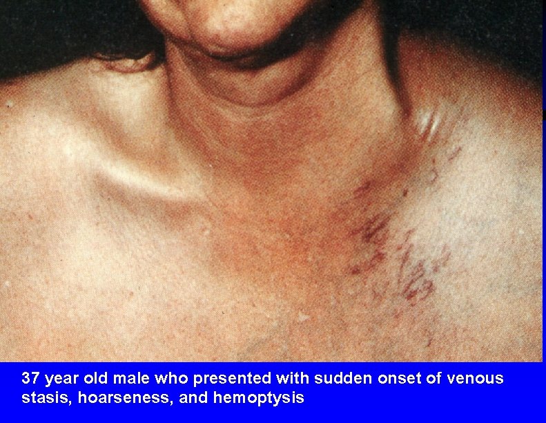 37 year old male who presented with sudden onset of venous stasis, hoarseness, and