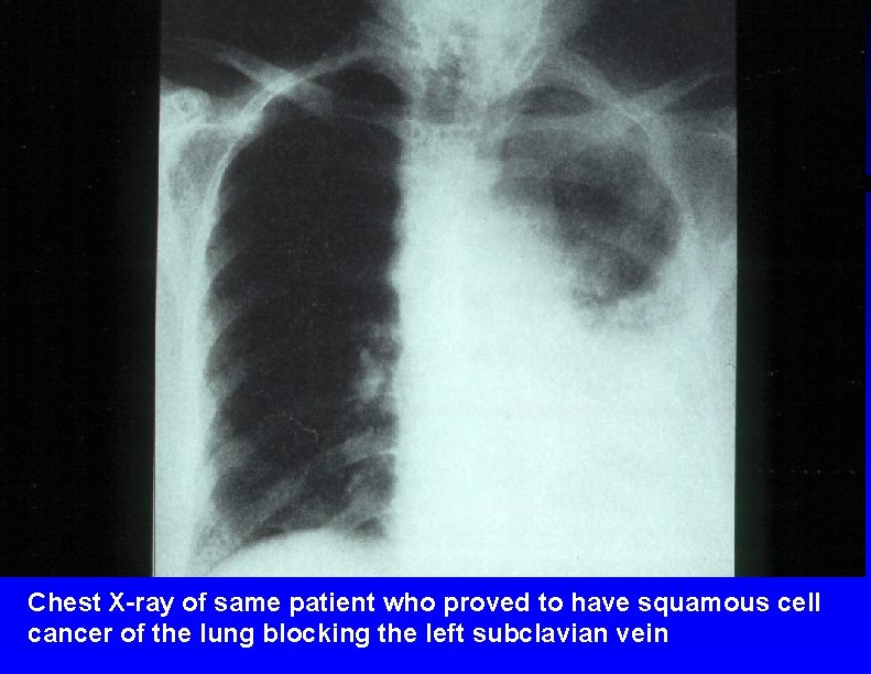 Chest X-ray of same patient who proved to have squamous cell cancer of the