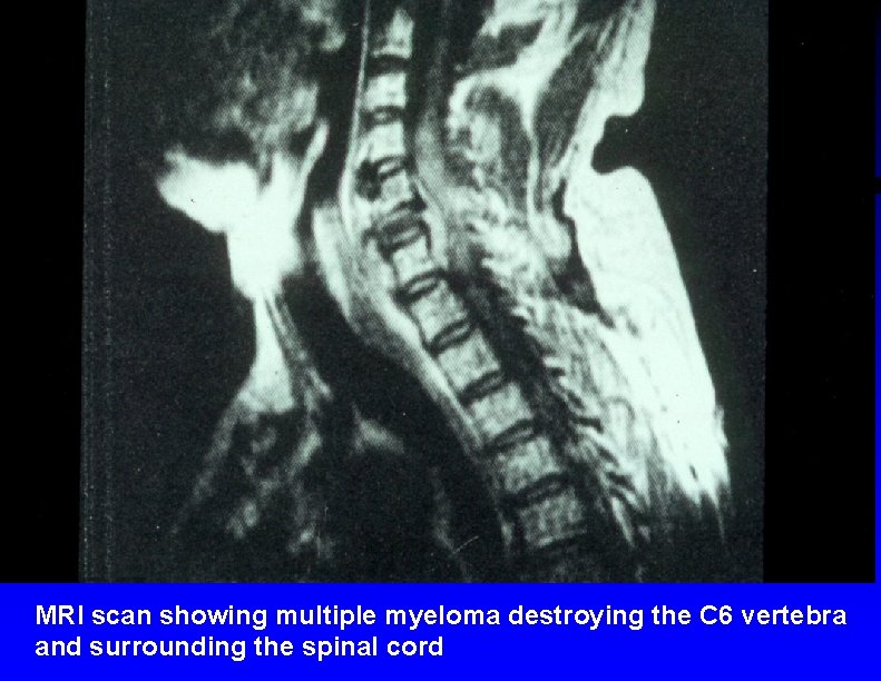 MRI scan showing multiple myeloma destroying the C 6 vertebra and surrounding the spinal