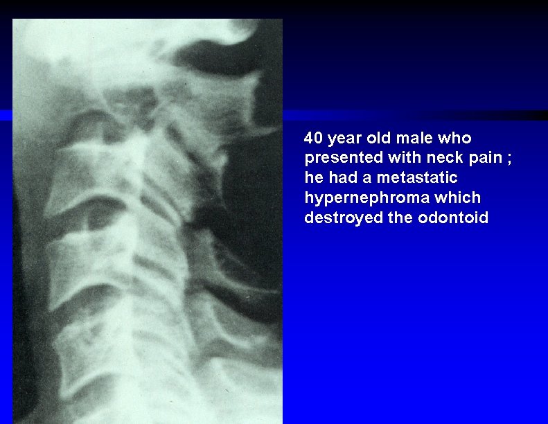 40 year old male who presented with neck pain ; he had a metastatic