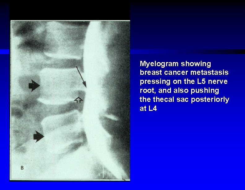 Myelogram showing breast cancer metastasis pressing on the L 5 nerve root, and also