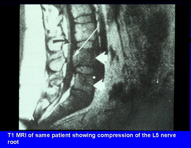 T 1 MRI of same patient showing compression of the L 5 nerve root