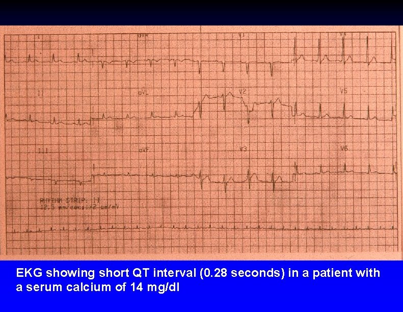 EKG showing short QT interval (0. 28 seconds) in a patient with a serum