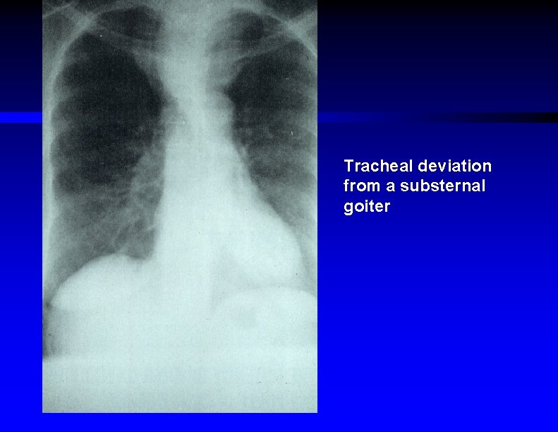 Tracheal deviation from a substernal goiter 