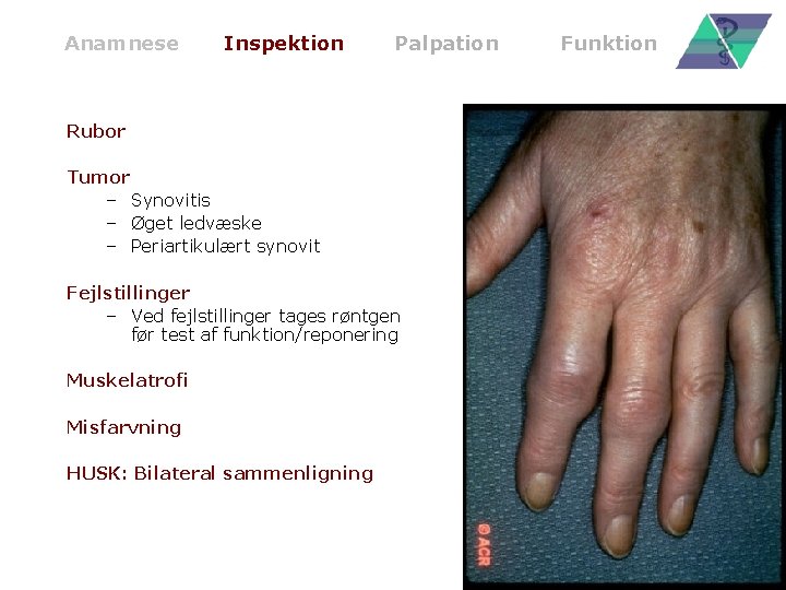 Anamnese Inspektion Palpation Rubor Tumor – Synovitis – Øget ledvæske – Periartikulært synovit Fejlstillinger