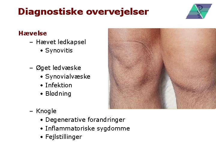 Diagnostiske overvejelser Hævelse – Hævet ledkapsel • Synovitis – Øget ledvæske • Synovialvæske •