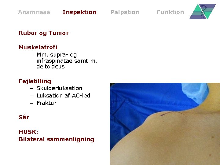 Anamnese Inspektion Rubor og Tumor Muskelatrofi – Mm. supra- og infraspinatae samt m. deltoideus