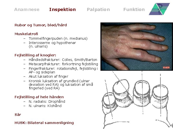 Anamnese Inspektion Palpation Rubor og Tumor, blød/hård Muskelatrofi – Tommelfingerpuden (n. medianus) – Interosserne