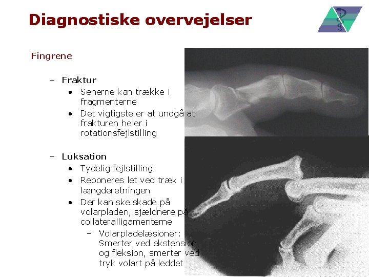 Diagnostiske overvejelser Fingrene – Fraktur • Senerne kan trække i fragmenterne • Det vigtigste
