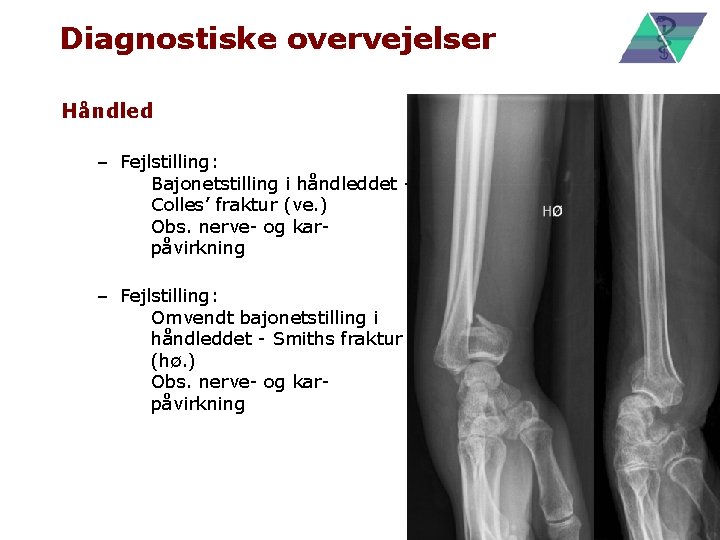 Diagnostiske overvejelser Håndled – Fejlstilling: • Bajonetstilling i håndleddet Colles’ fraktur (ve. ) •