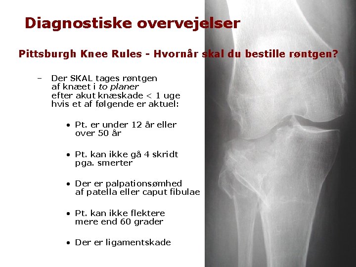 Diagnostiske overvejelser Pittsburgh Knee Rules - Hvornår skal du bestille røntgen? – Der SKAL