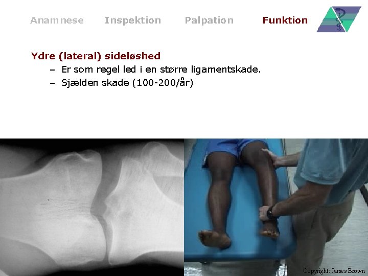 Anamnese Inspektion Palpation Funktion Ydre (lateral) sideløshed – Er som regel led i en