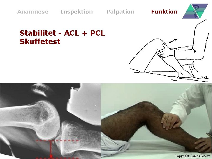 Anamnese Inspektion Palpation Funktion Stabilitet - ACL + PCL Skuffetest Copyright: James Brown 