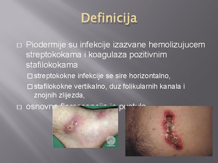 Definicija � Piodermije su infekcije izazvane hemolizujucem streptokokama i koagulaza pozitivnim stafilokokama � streptokokne