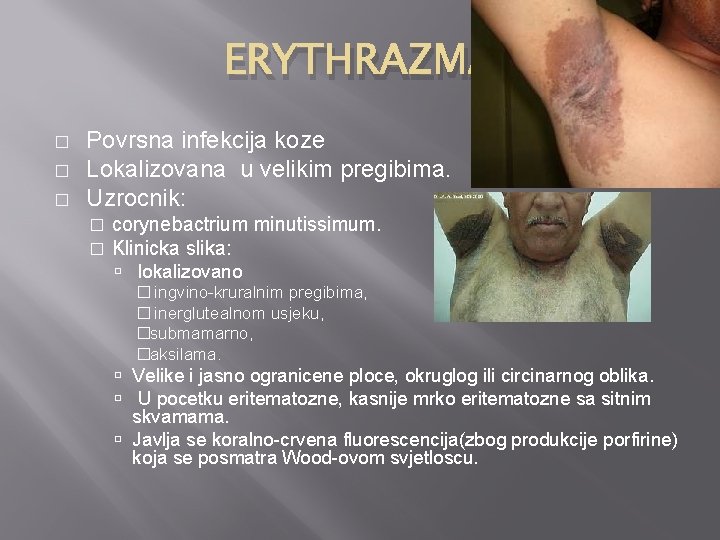 ERYTHRAZMA � � � Povrsna infekcija koze Lokalizovana u velikim pregibima. Uzrocnik: � �