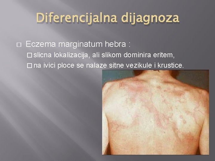 Diferencijalna dijagnoza � Eczema marginatum hebra : � slicna lokalizacija, ali slikom dominira eritem,