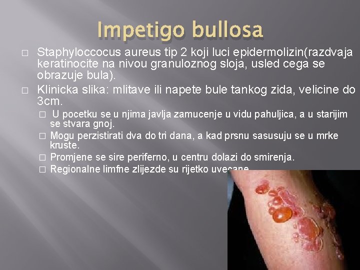 Impetigo bullosa � � Staphyloccocus aureus tip 2 koji luci epidermolizin(razdvaja keratinocite na nivou