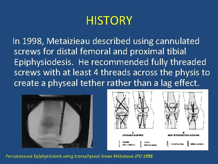 HISTORY In 1998, Metaizieau described using cannulated screws for distal femoral and proximal tibial