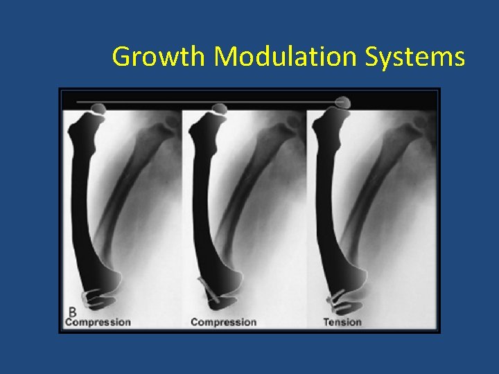 Growth Modulation Systems 