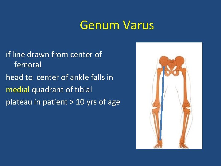 Genum Varus if line drawn from center of femoral head to center of ankle