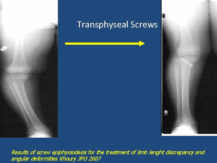 Transphyseal Screws Results of screw epiphysiodesis for the treatment of limb lenght discrepancy and