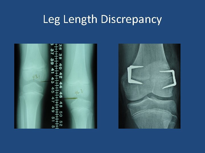 Leg Length Discrepancy 