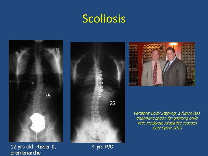 Scoliosis 35 22 Vertebral Body Stapling: a fusion less treatment option for growing child