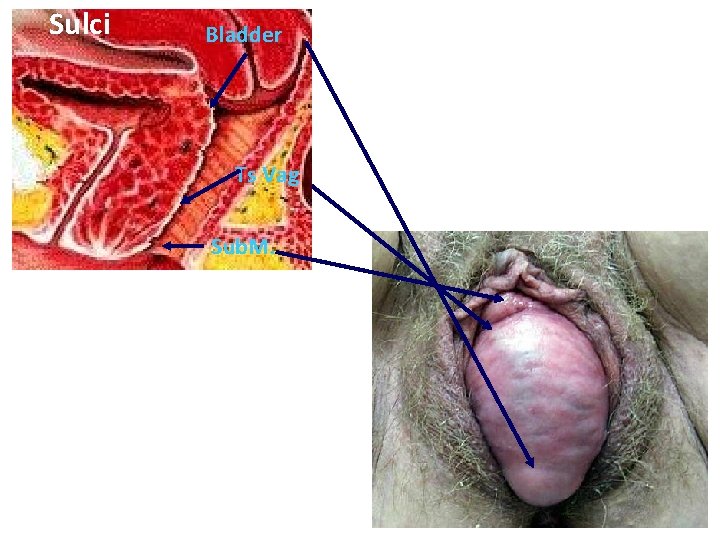 Sulci Bladder Ts Vag Sub. M. 4 