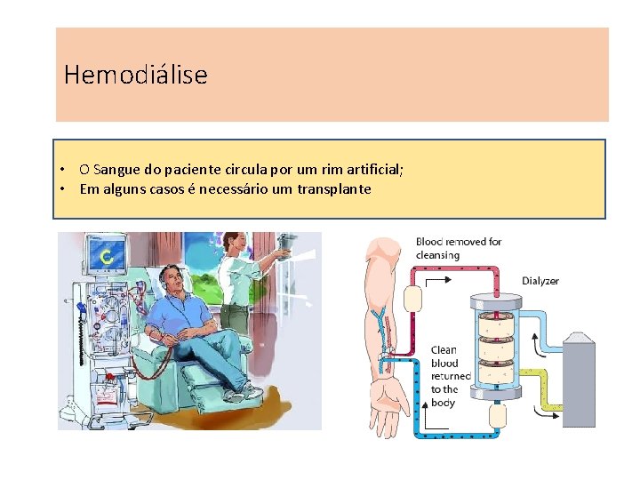 Hemodiálise • O Sangue do paciente circula por um rim artificial; • Em alguns Hemodiálise • O Sangue do paciente circula por um rim artificial; • Em alguns