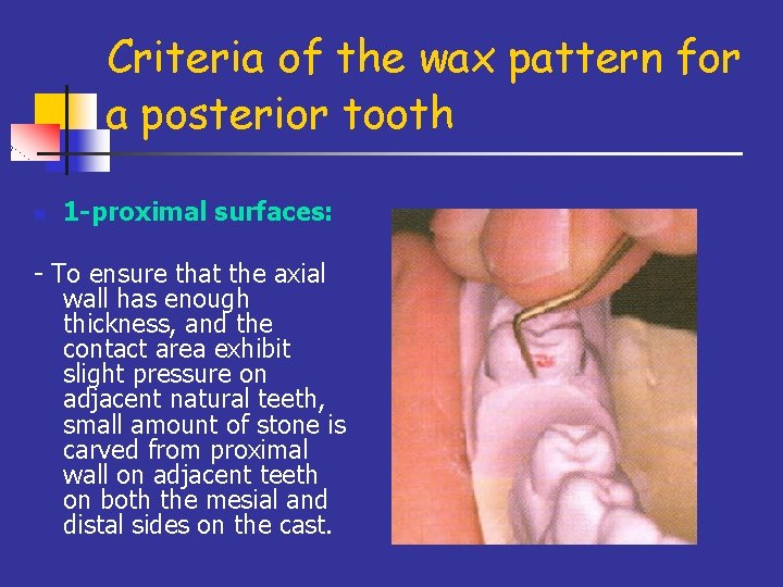 Criteria of the wax pattern for a posterior tooth n 1 -proximal surfaces: -