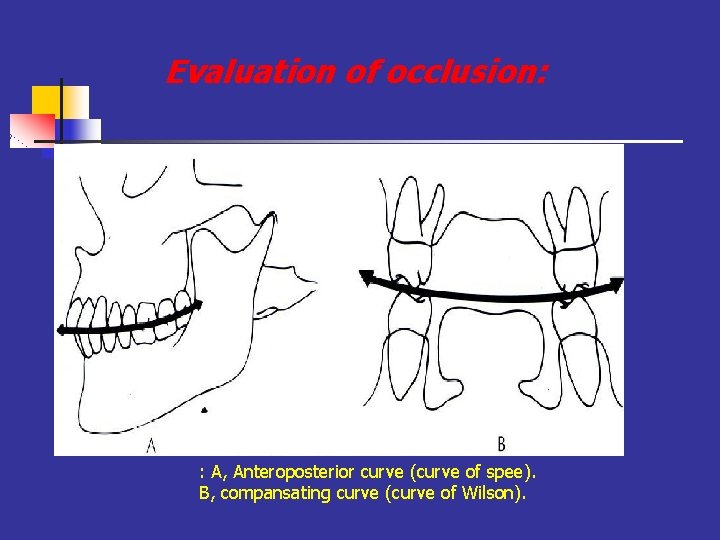 Evaluation of occlusion: : A, Anteroposterior curve (curve of spee). B, compansating curve (curve