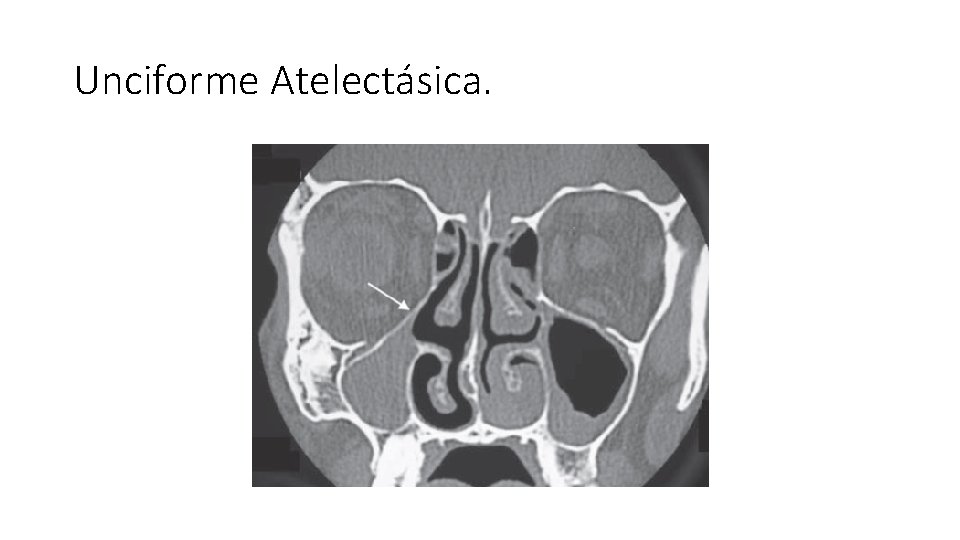 Unciforme Atelectásica. 