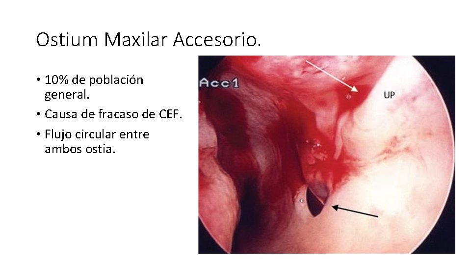 Ostium Maxilar Accesorio. • 10% de población general. • Causa de fracaso de CEF.