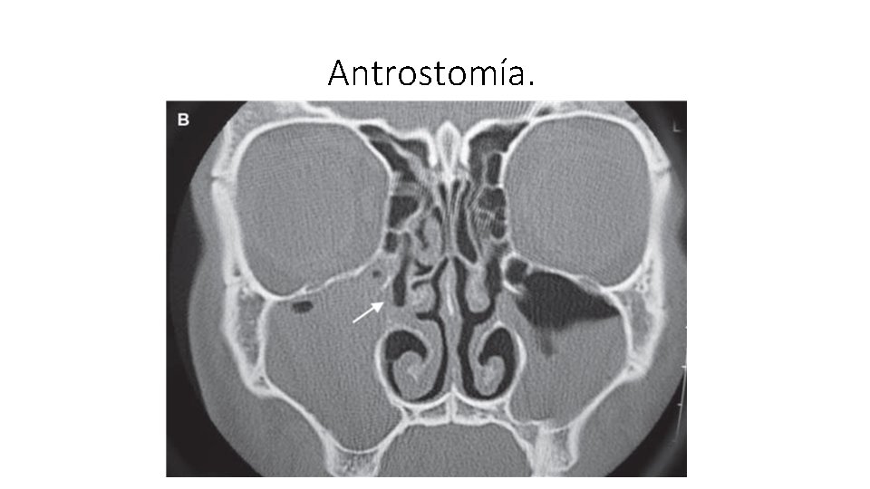 Antrostomía. 