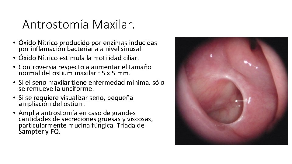 Antrostomía Maxilar. • Óxido Nítrico producido por enzimas inducidas por inflamación bacteriana a nivel