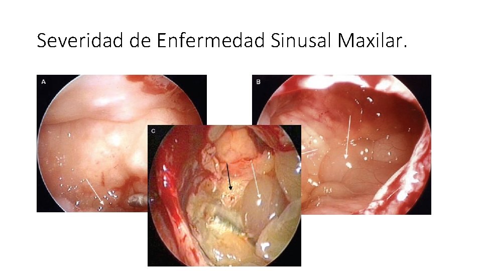 Severidad de Enfermedad Sinusal Maxilar. 