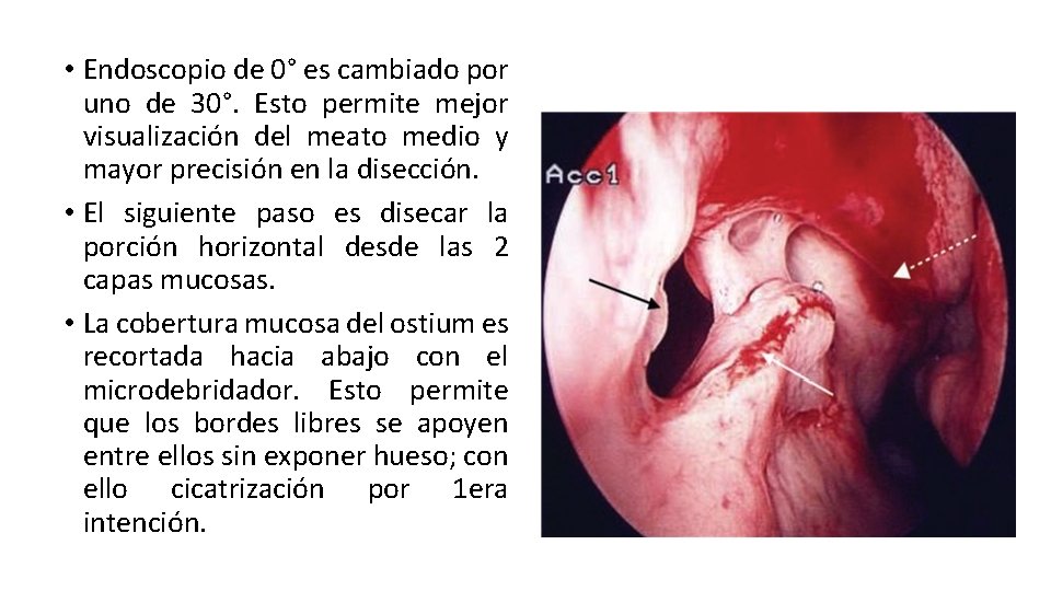  • Endoscopio de 0° es cambiado por uno de 30°. Esto permite mejor
