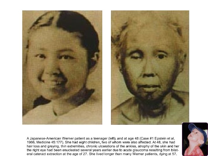Werner Patient Teenager Age 48 